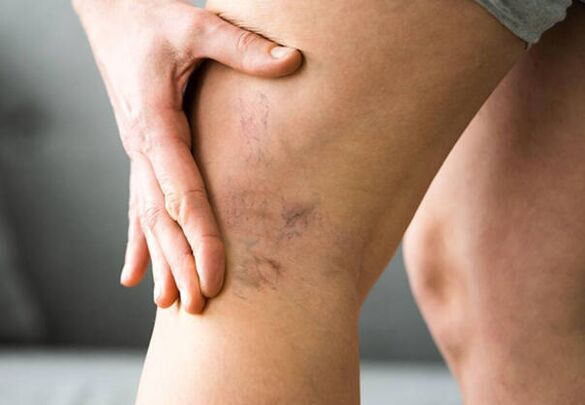 Levicose protects legs from developing varicose veins