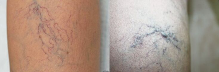 Varicose veins symptoms