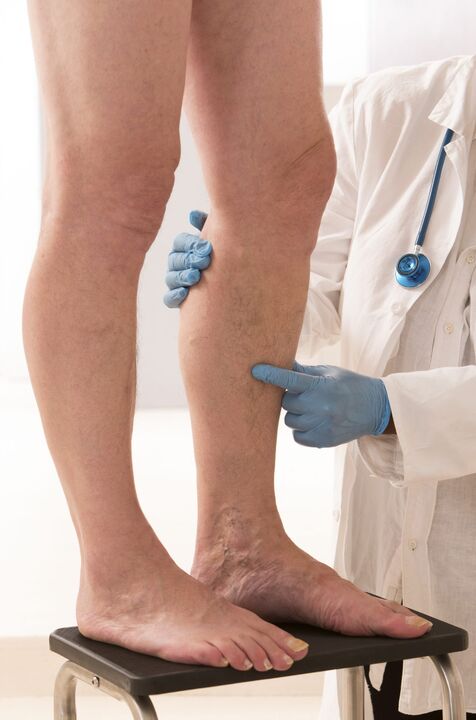 Varicosis What is