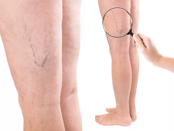 Veins varicose veins in women