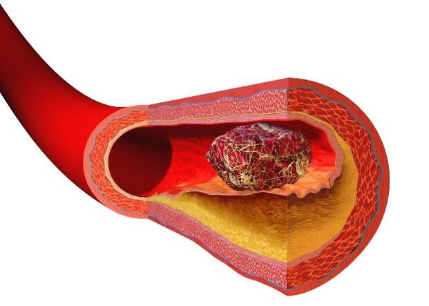thrombus