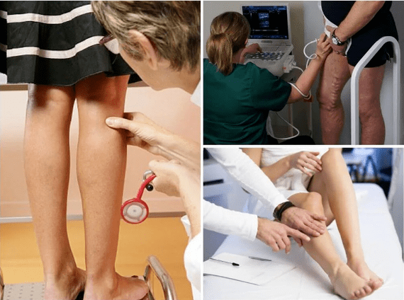 Varicose veins in the legs