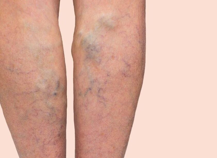 How are veins varicose veins