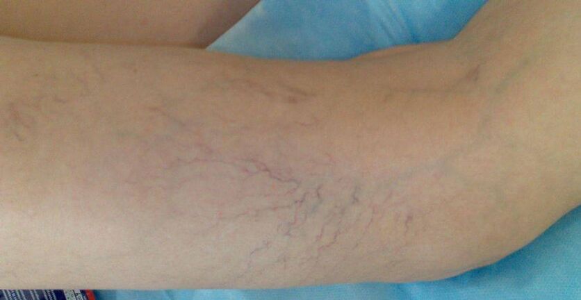 Vascular stars in the legs