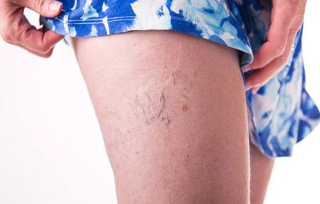 Vein varicose veins