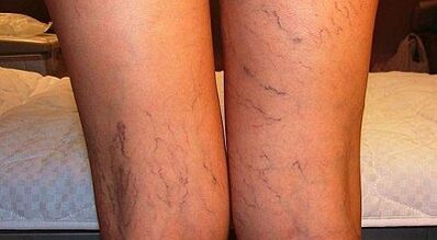 How to treat varicone expansion in women in women