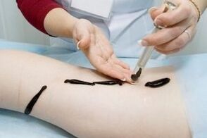 application of leeches to treat varicose veins