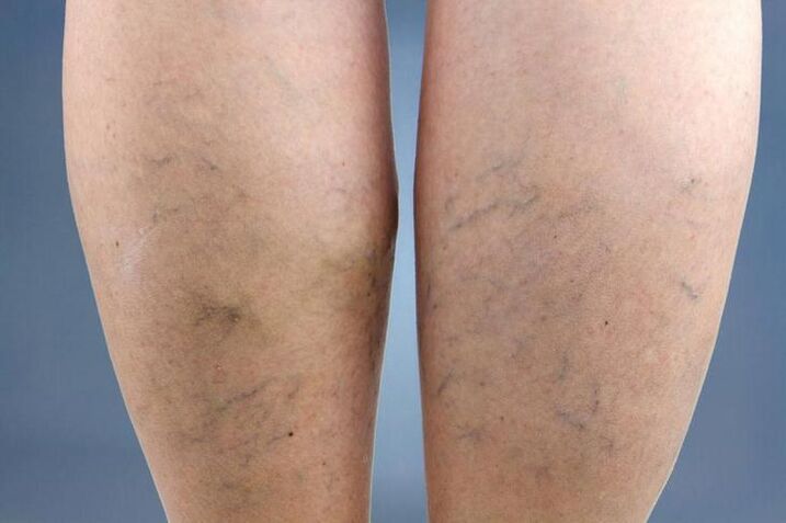 symptoms of varicose veins in legs