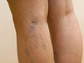 Protruding veins under the skin are a symptom of varicose veins in the legs