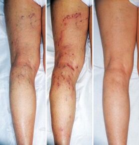 The result of treating varicose veins of the lower extremities