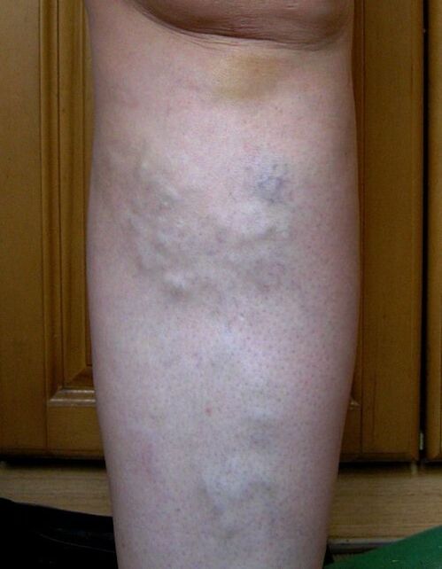 Swollen veins on the leg due to varicose veins